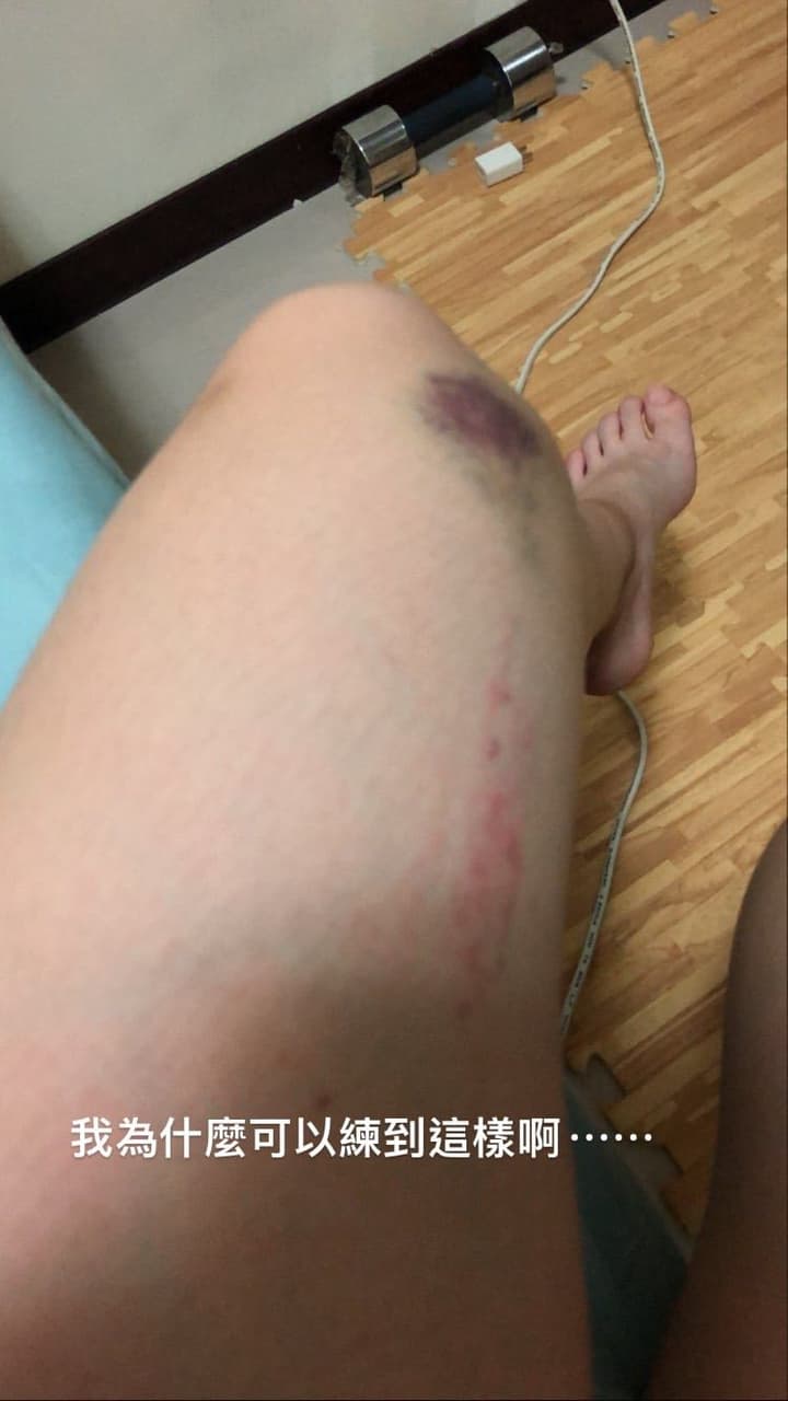 重訓瘀青- 健身板| Dcard