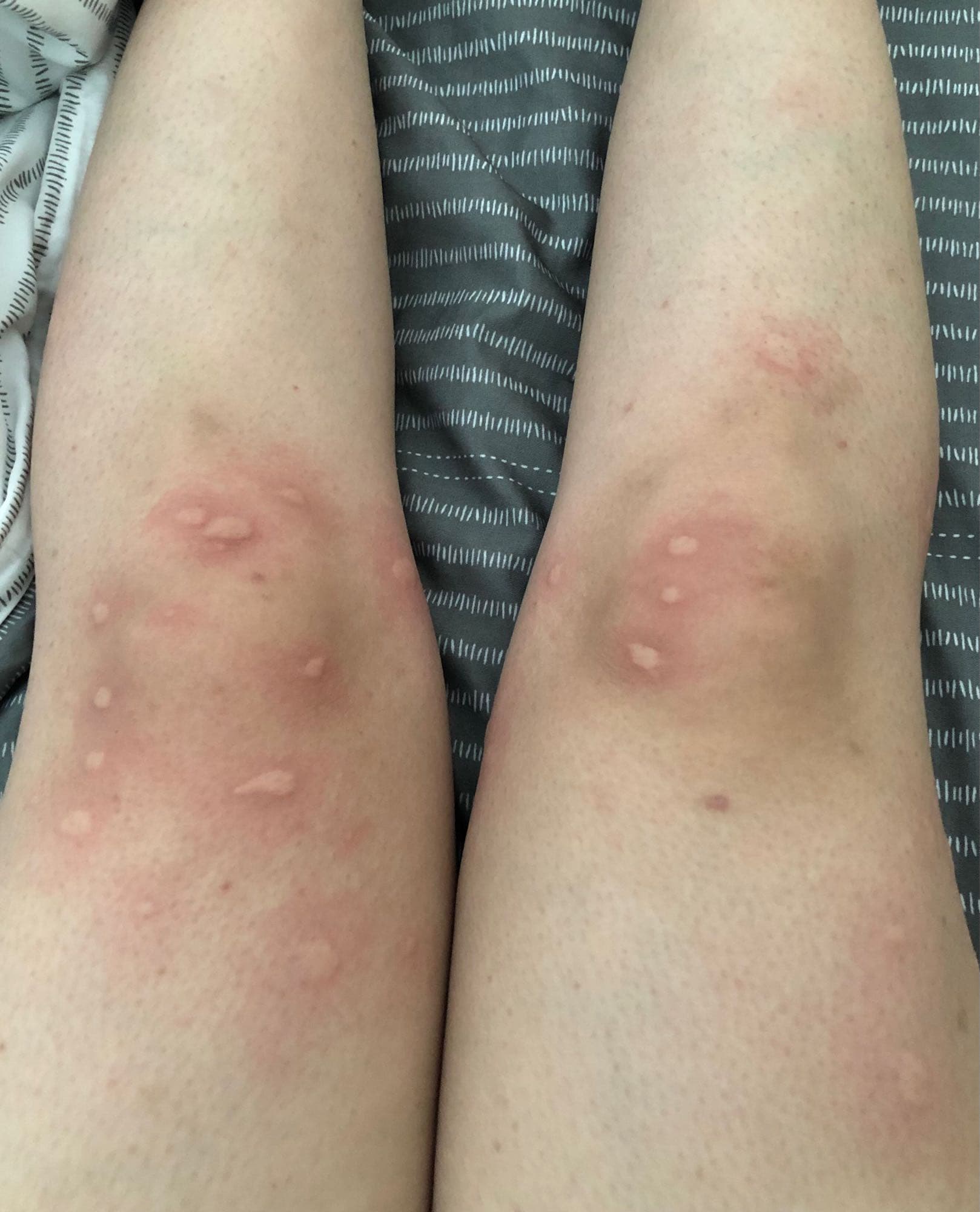 #更我被小黑蚊圍毆- 閒聊板| Dcard