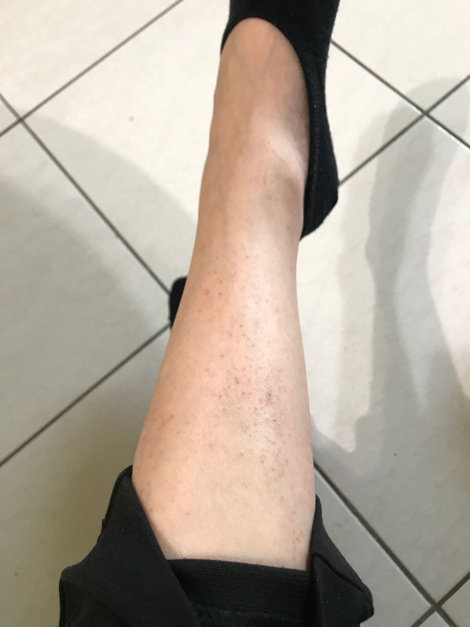 求救！腳上出現小紅點- 心情板| Dcard