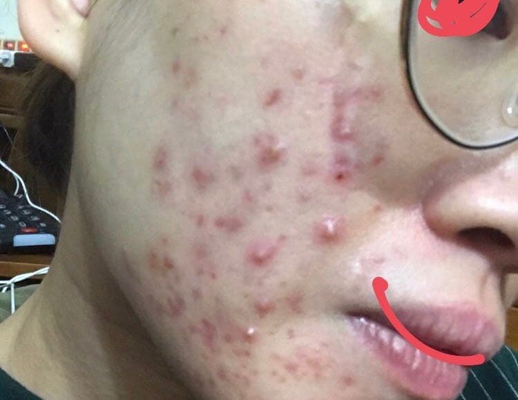 請益 服用口服a酸初期爆痘爆得很誇張 有照慎入 Cplife板 Disp Bbs