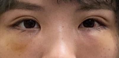 詢問眼袋內開手術 醫美板 Dcard