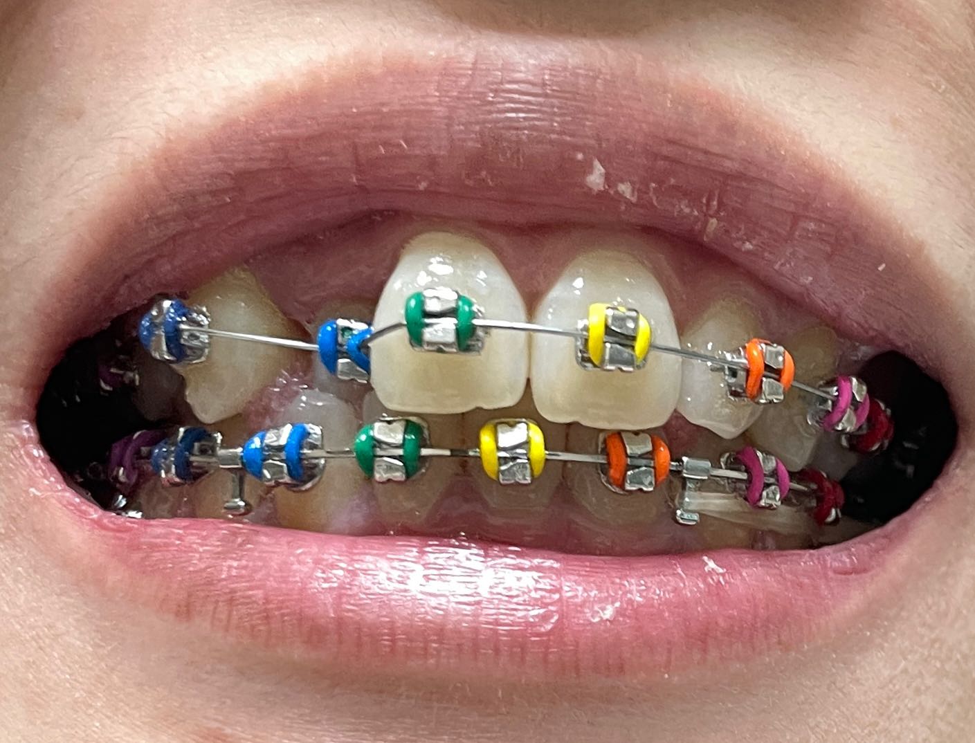 牙套回診第三次- 牙齒矯正板| Dcard