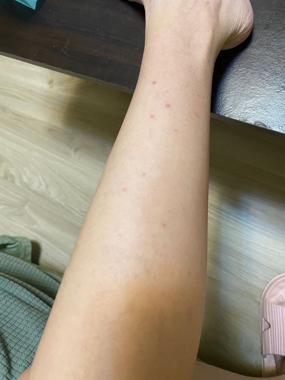 有人過這樣嗎？腿上突然冒出一點一點的紅點- 女孩板| Dcard