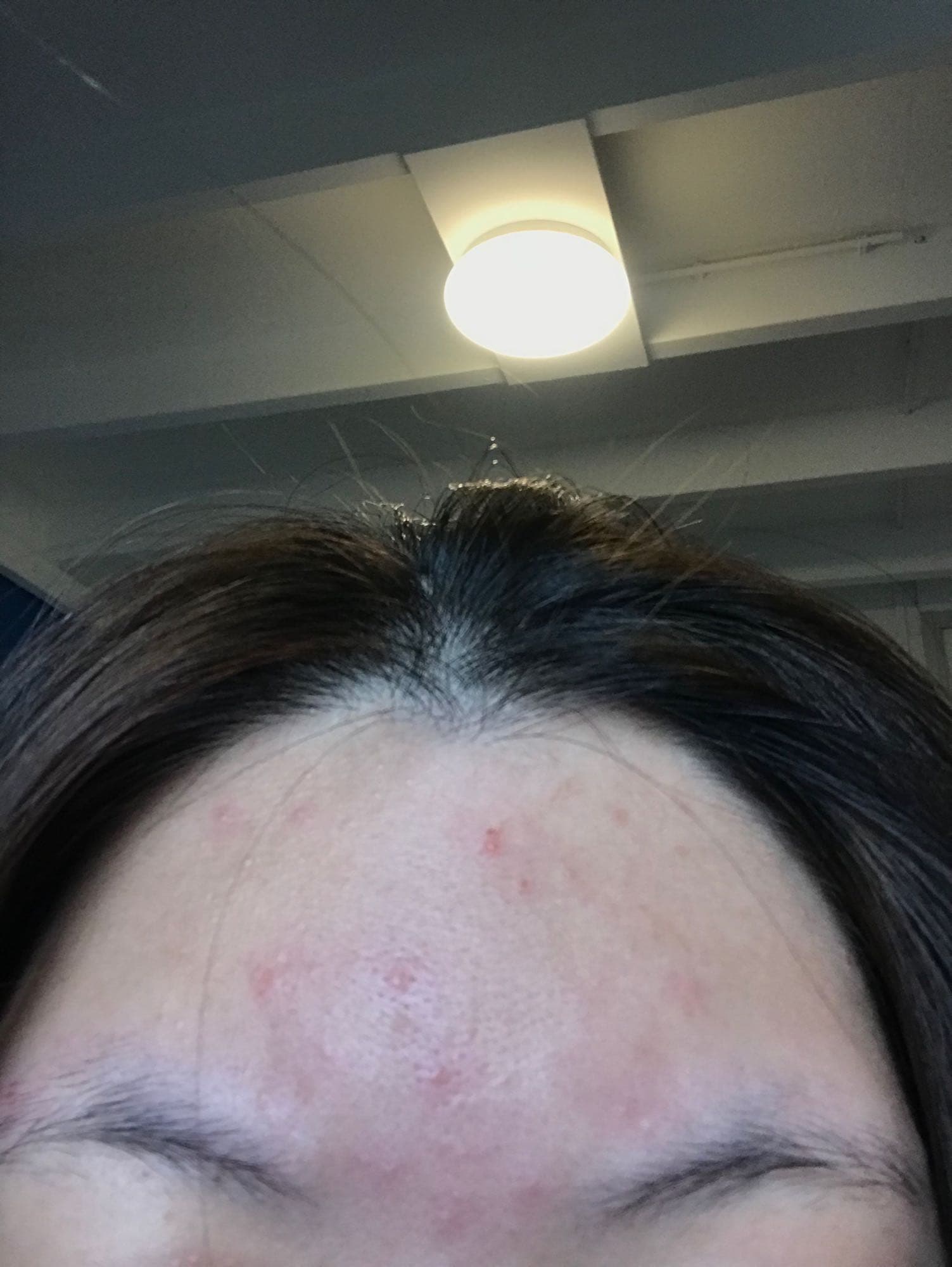 請益在國外額頭起一堆紅點點怎麼辦- 美妝板| Dcard