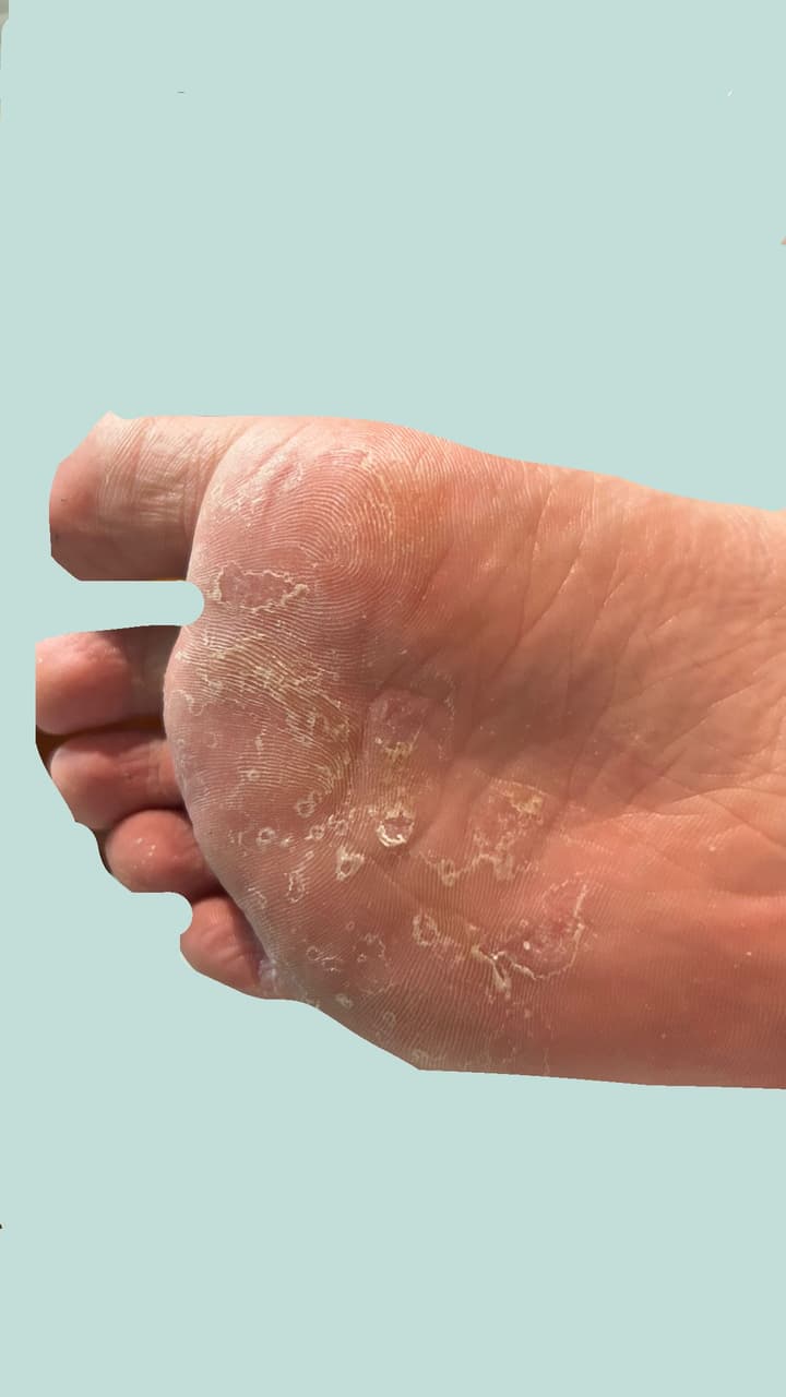 求助 腳底好不了的水泡硬皮 內有圖慎入 - 閒聊板 | Dcard