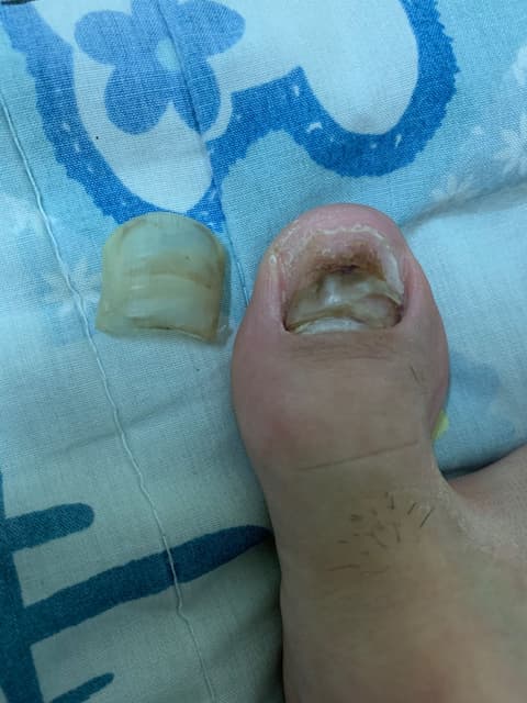 有圖慎入掉下來的大拇指腳指甲 有趣板 Dcard