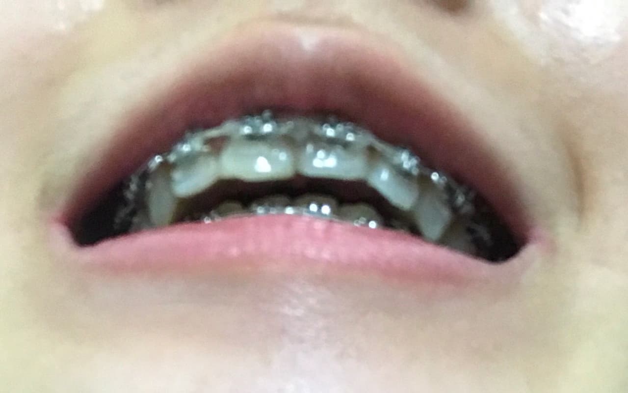 megapx