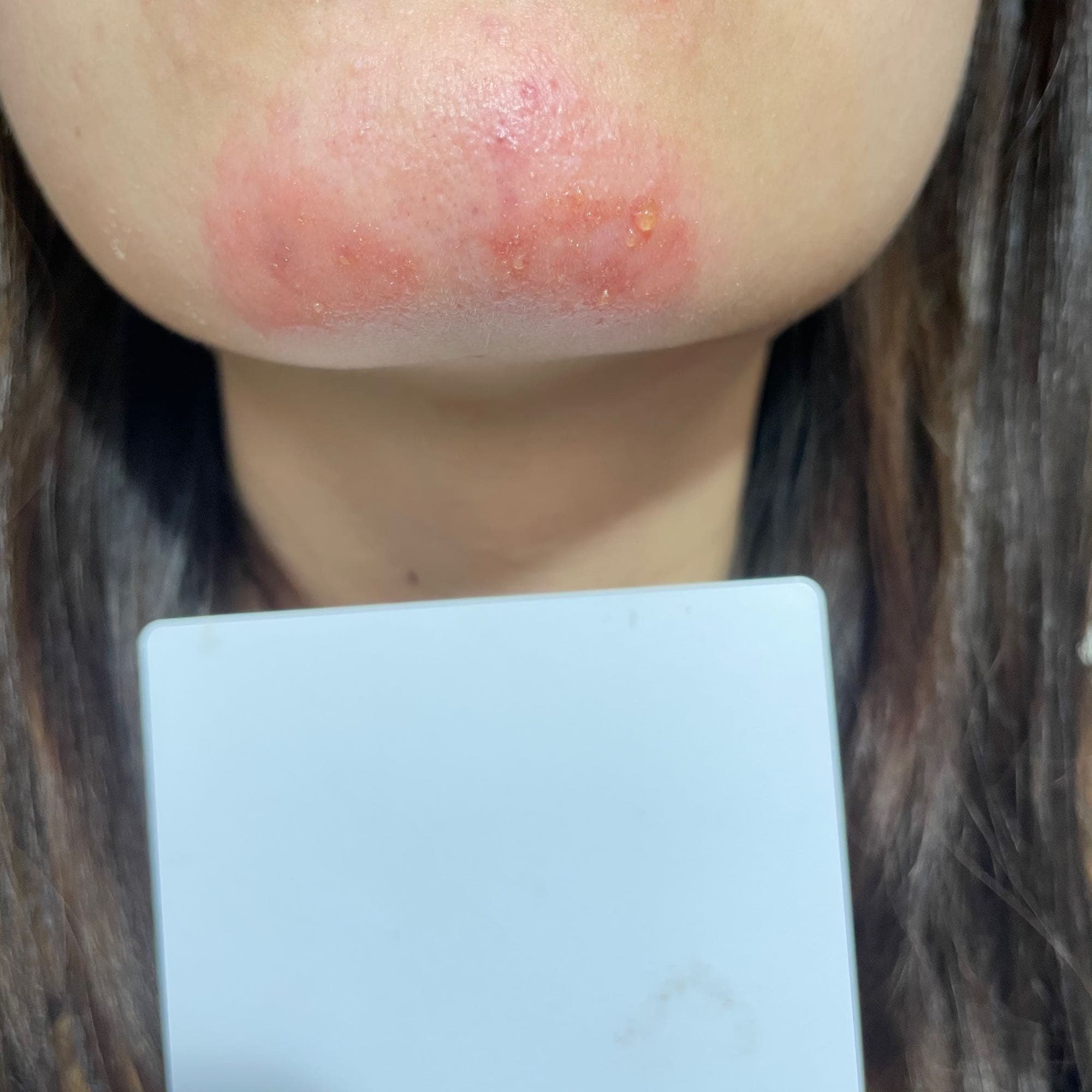 下巴突然腫一塊❤️ Best adult photos at mikas.help