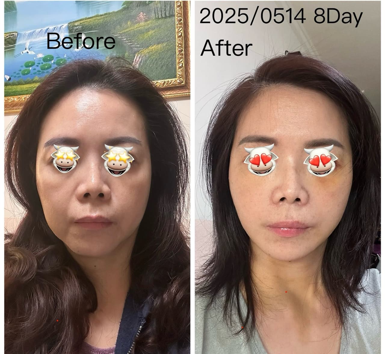 拉皮的最新討論 | Dcard