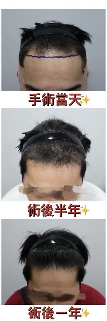 #分享 雄性禿鬼剃頭改造!桃園風華ㄩ髮髮際線植髮一年成果 - 美髮板 | Dcard
