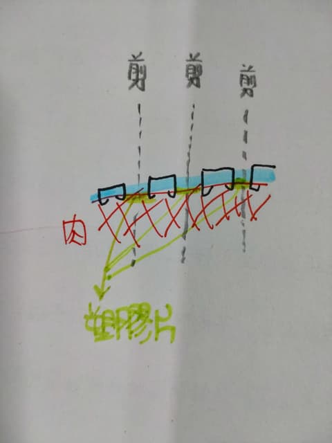 一次環切包皮手術,術後拔釘工具 - 男性保養板 | Dcard