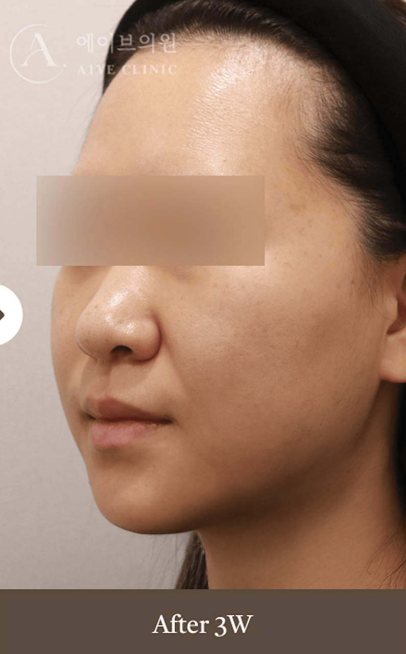 韓國明星都在做！最強「InMode LIFT」電波拉提：溶脂、緊膚、嫩膚一次到位！ - 韓國AIVE皮膚科 (@aive_dr_jun ...