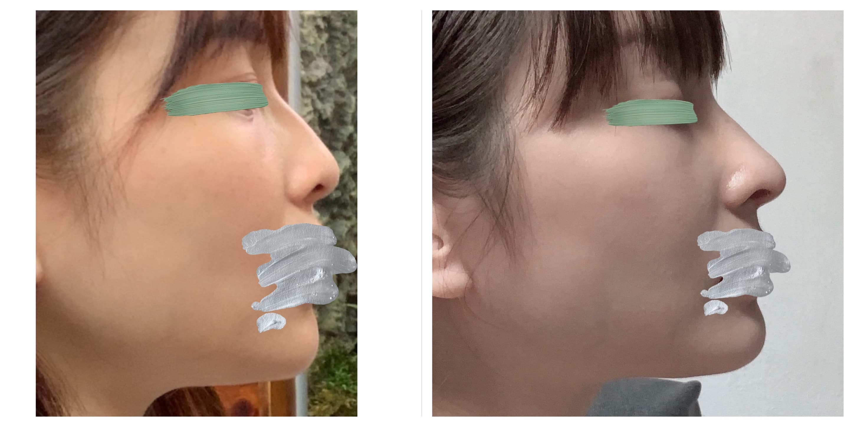 自肋結構式鼻整形 - 同時矯正鼻駝峰、鼻中膈彎曲 - 林漢琛醫師 耳鼻喉頭頸外科