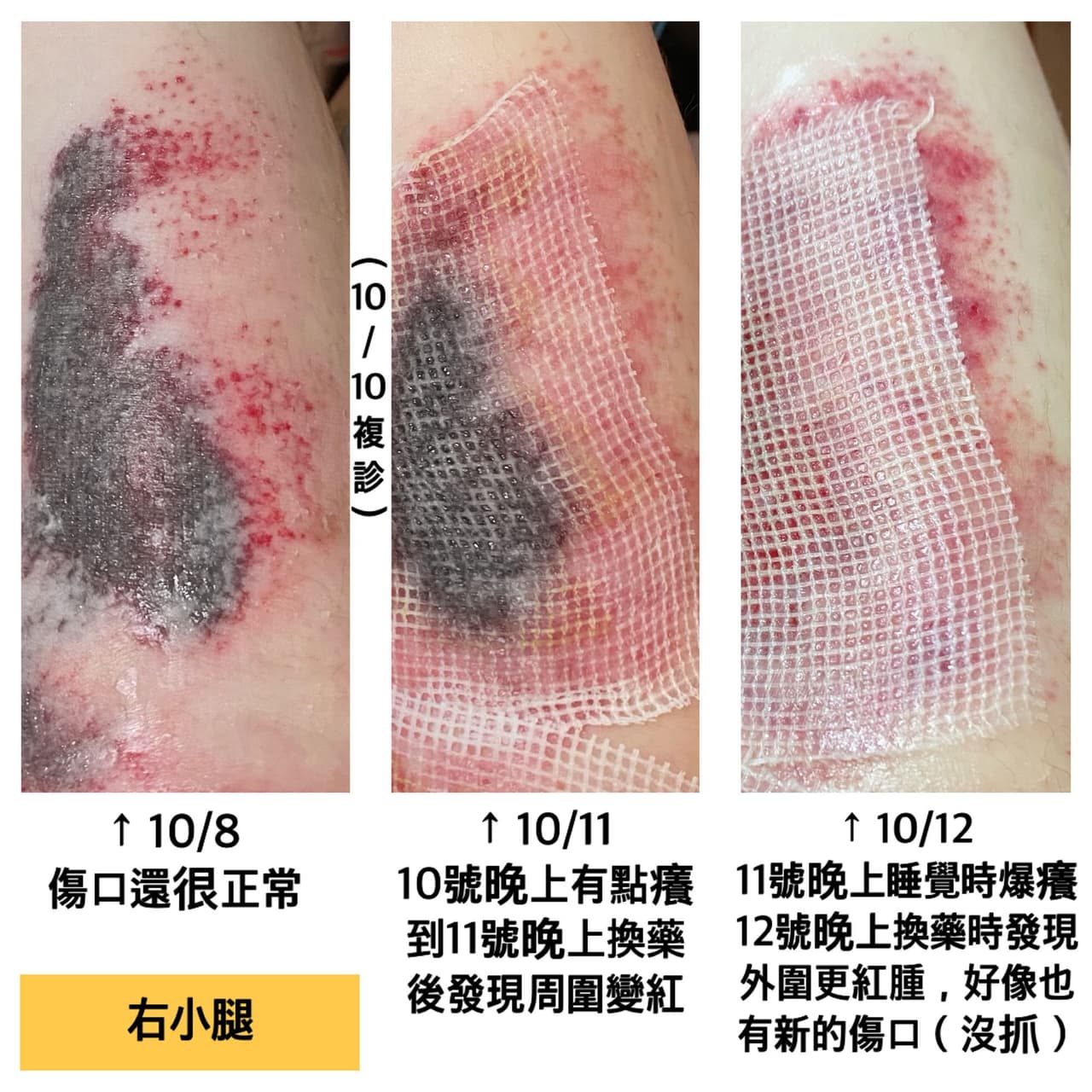 傷口這樣是惡化了嗎?(有圖慎入) - 閒聊板 | Dcard
