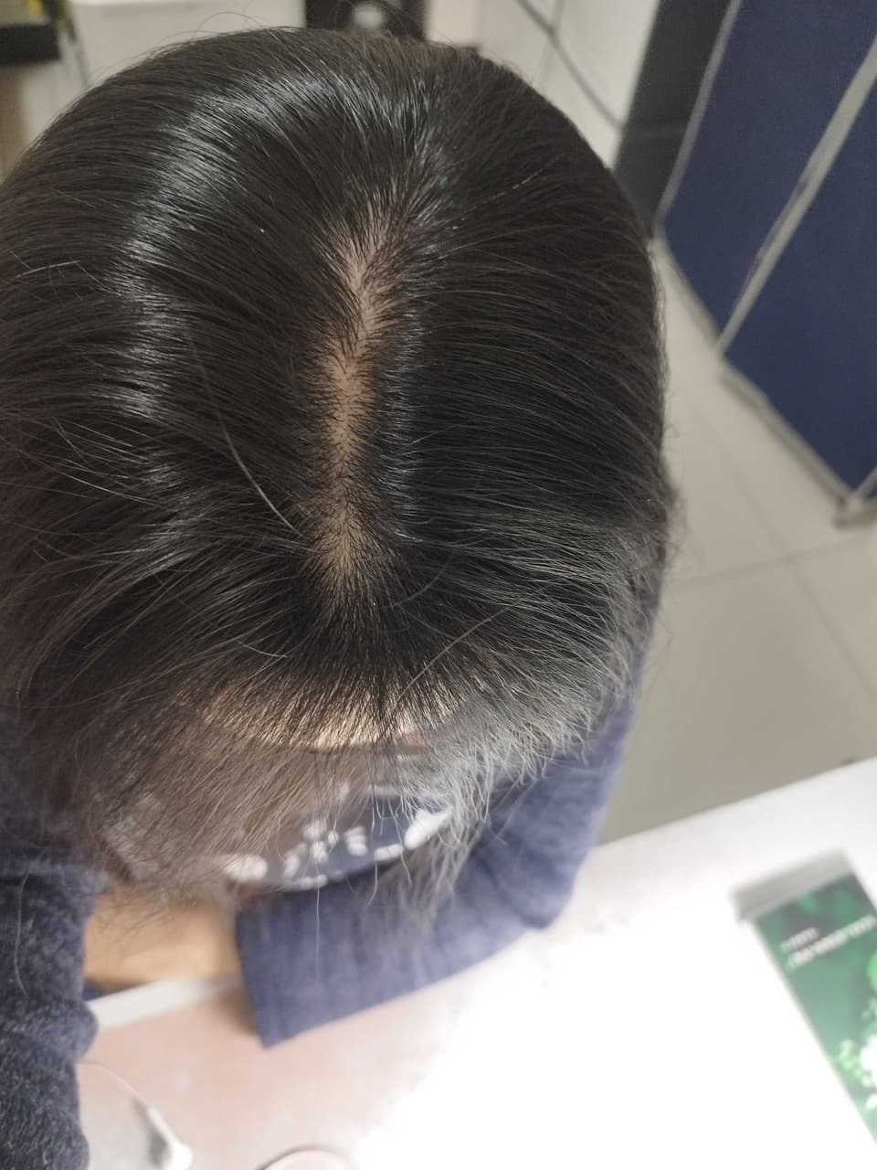 #分享 斑禿/鬼剃頭治療歷程 - 美髮板 | Dcard