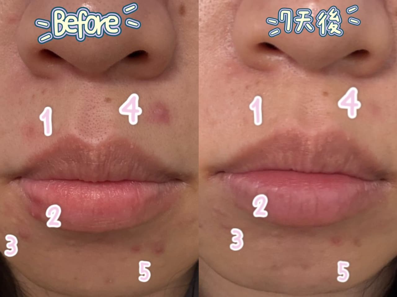 megapx