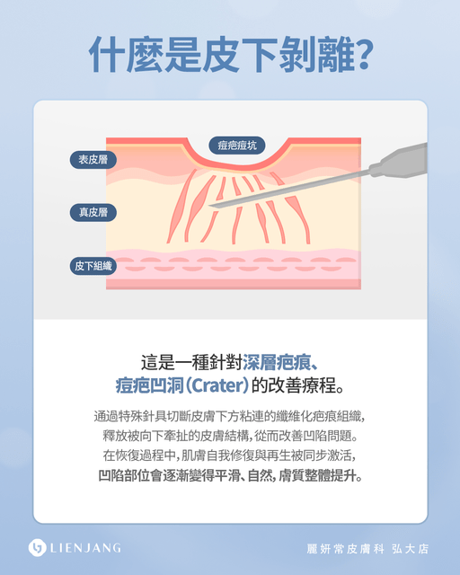 為什麼很多皮膚科醫生建议痘疤治療做皮下剝離？ - 韓國醫美 麗妍常 (@lienjang) | Dcard