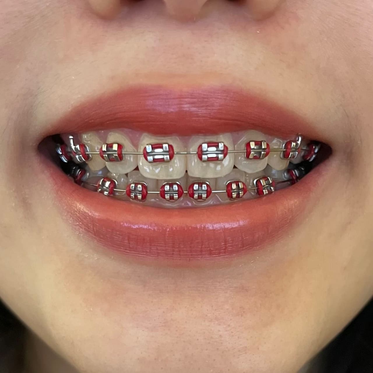 牙套顏色紀錄❛˓◞˂̵✧ - 牙齒矯正板| Dcard