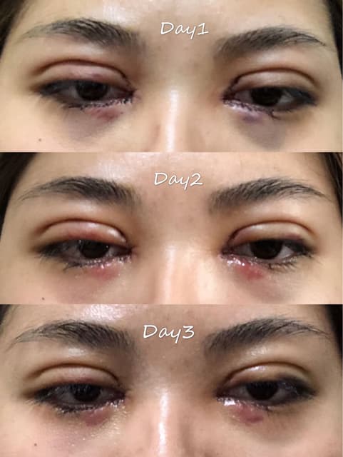 心得台中新彩雙眼皮手術 美妝板 Dcard