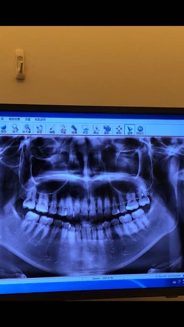 沒有智齒 牙齒矯正板 Dcard