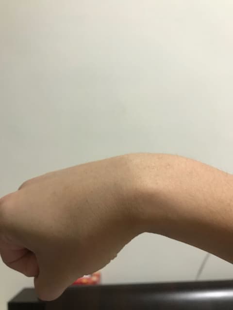 圖 我的腱鞘囊腫 心情板 Dcard