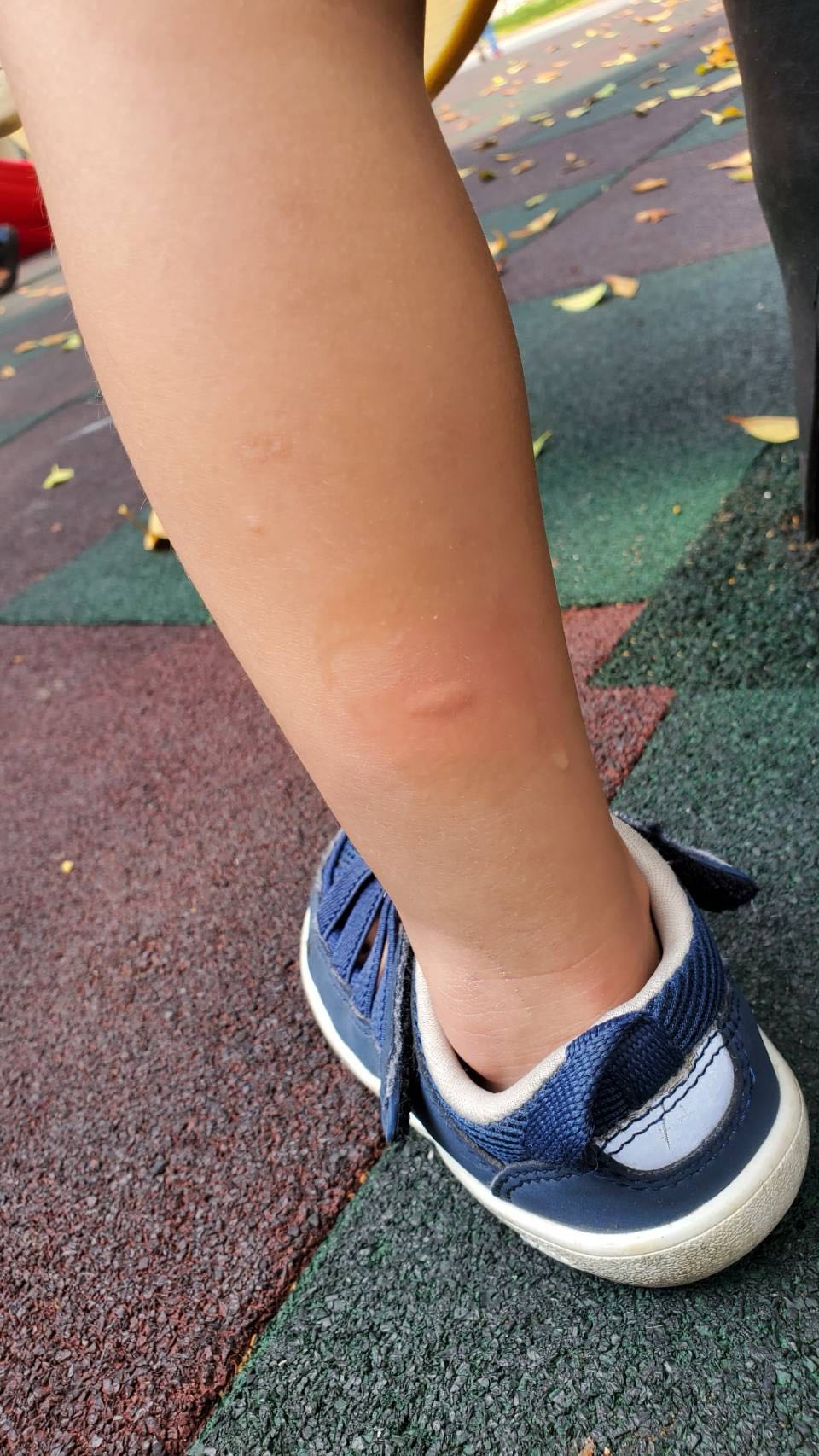 分享大人小孩都能用的無比寶貝止癢液~ - 親子板| Dcard