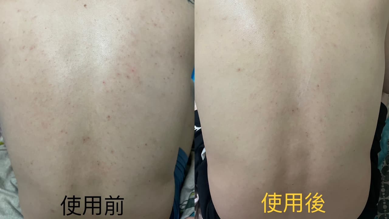 #分享 把背部清粉刺的錢,拿去投資這罐吧..... - 美妝板 | Dcard