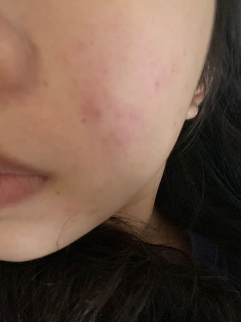 去痘淡痘疤選擇 美妝板 Dcard