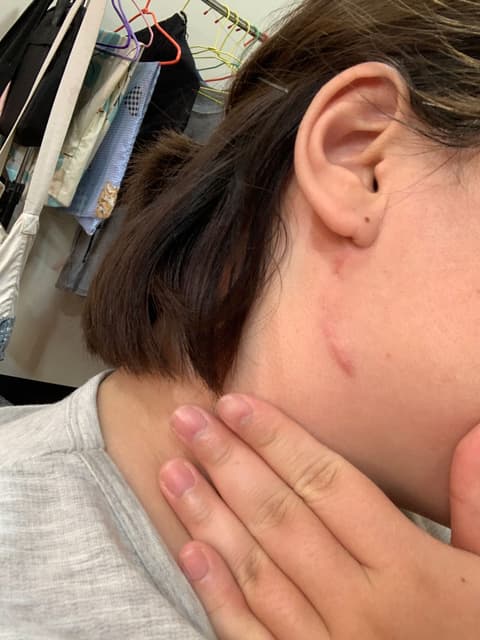 腮腺腫瘤住院記 閒聊板 Dcard