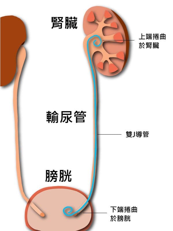馬眼與導管的故事，我得過腎結石(下) 文長 - 心情板 | Dcard