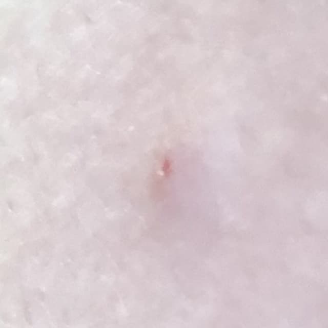 背上的黑粉刺(圖 - 美妝板 | Dcard