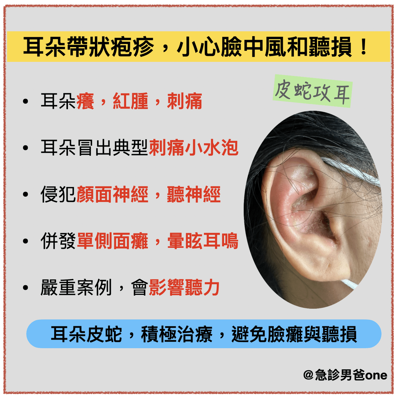 耳朵帶狀疱疹 - 閒聊板 | Dcard