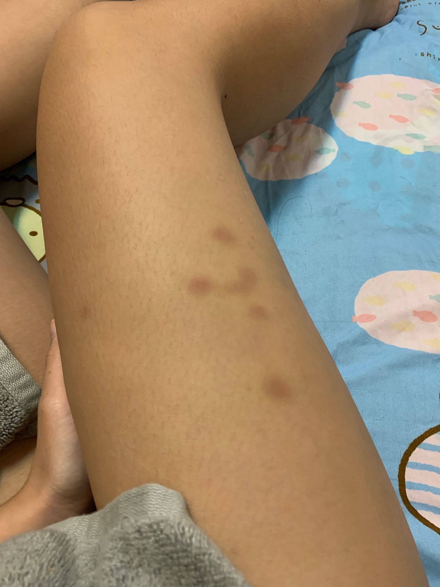 重訓瘀青- 健身板| Dcard