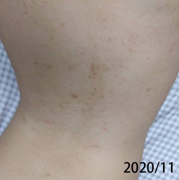 #分享 背痘、背痘疤痊癒方法分享(有圖) - 美妝板 | Dcard