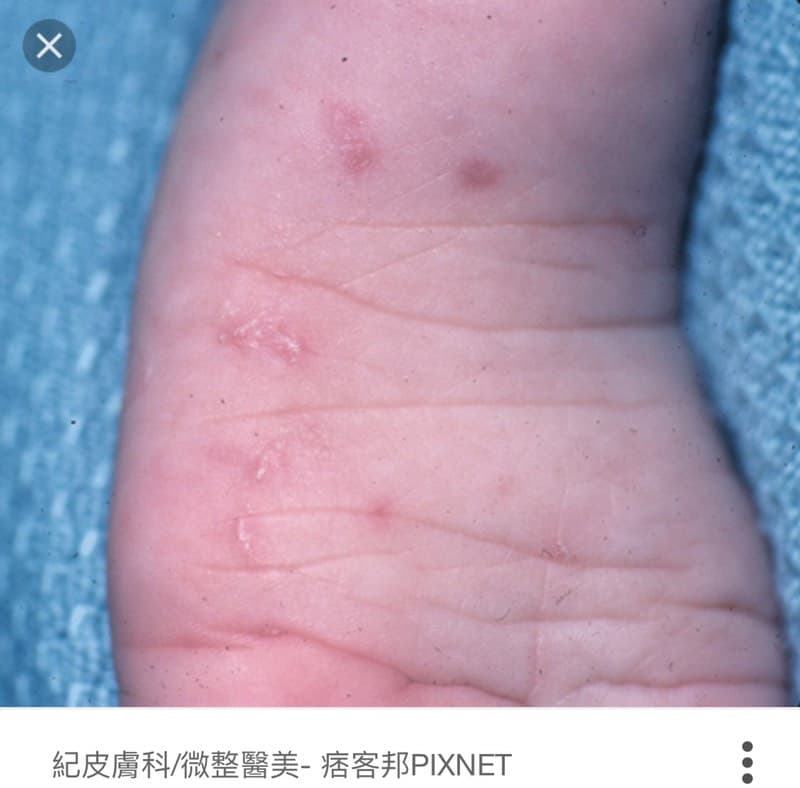 疥瘡 可怕的外星蟲蟲 #文長 - B25 留言 | Dcard