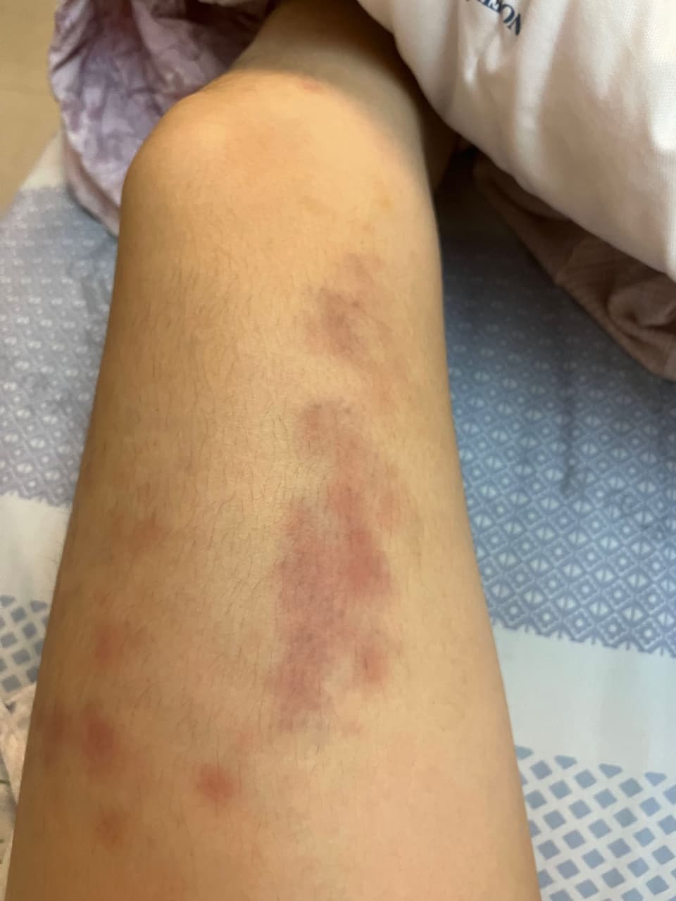 請益😭筋膜槍或瑜珈棍棒用到大瘀青- 健身板| Dcard