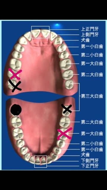 戴牙套還是植牙好 牙齒矯正板 Dcard