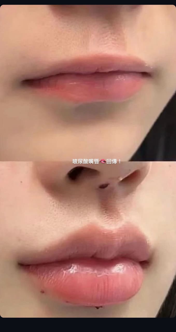 #詢問 請問上圖是修圖出來的嗎？ - 醫美板 | Dcard