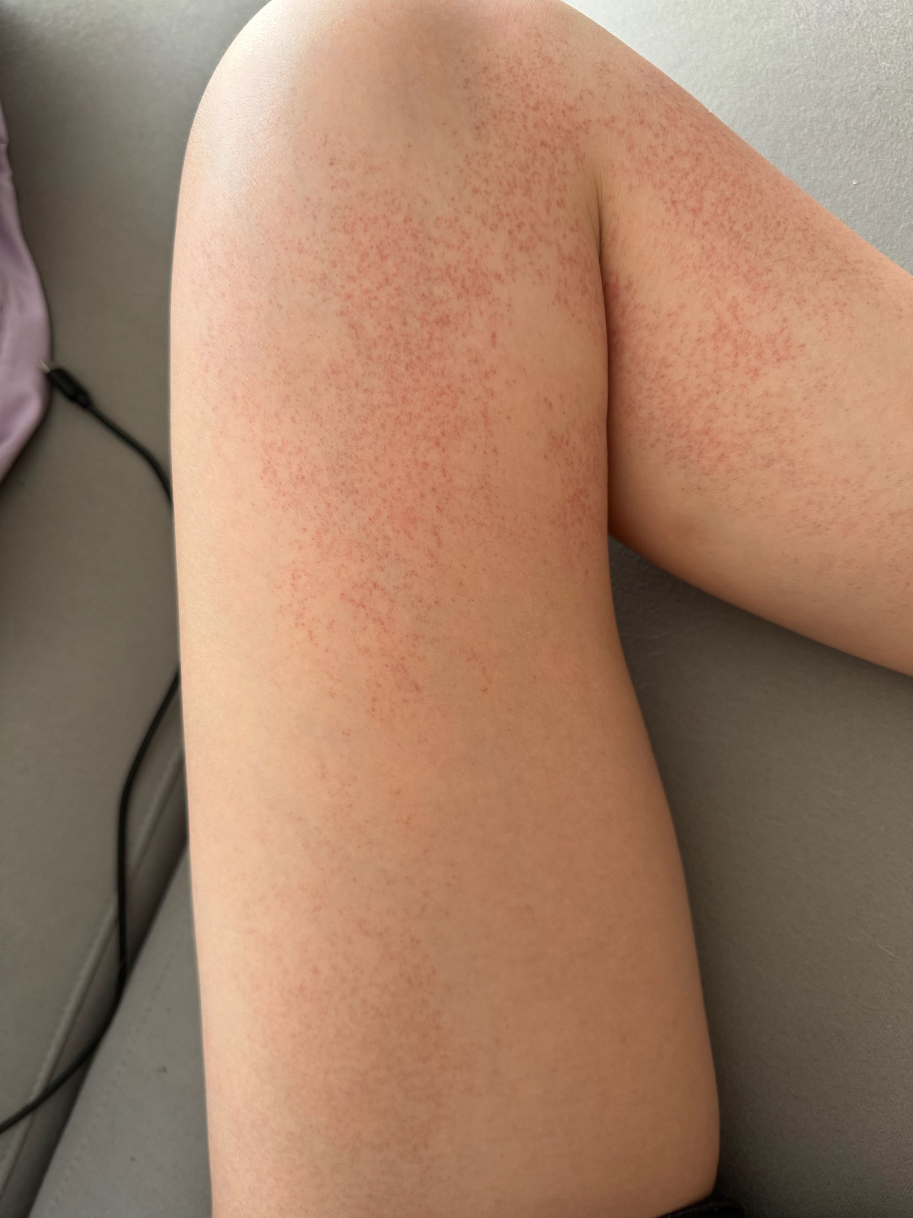 腿上莫名長好多紅點😭 - 女孩板| Dcard