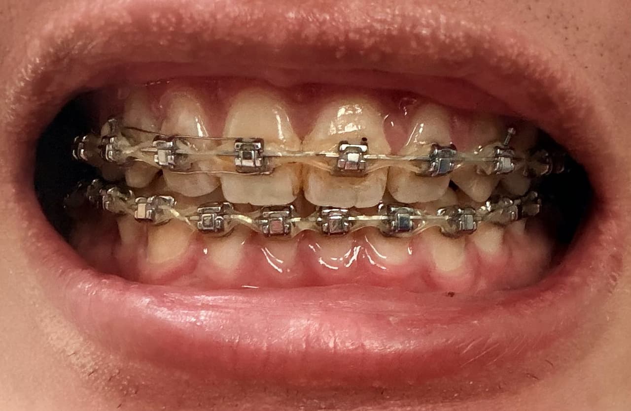 megapx