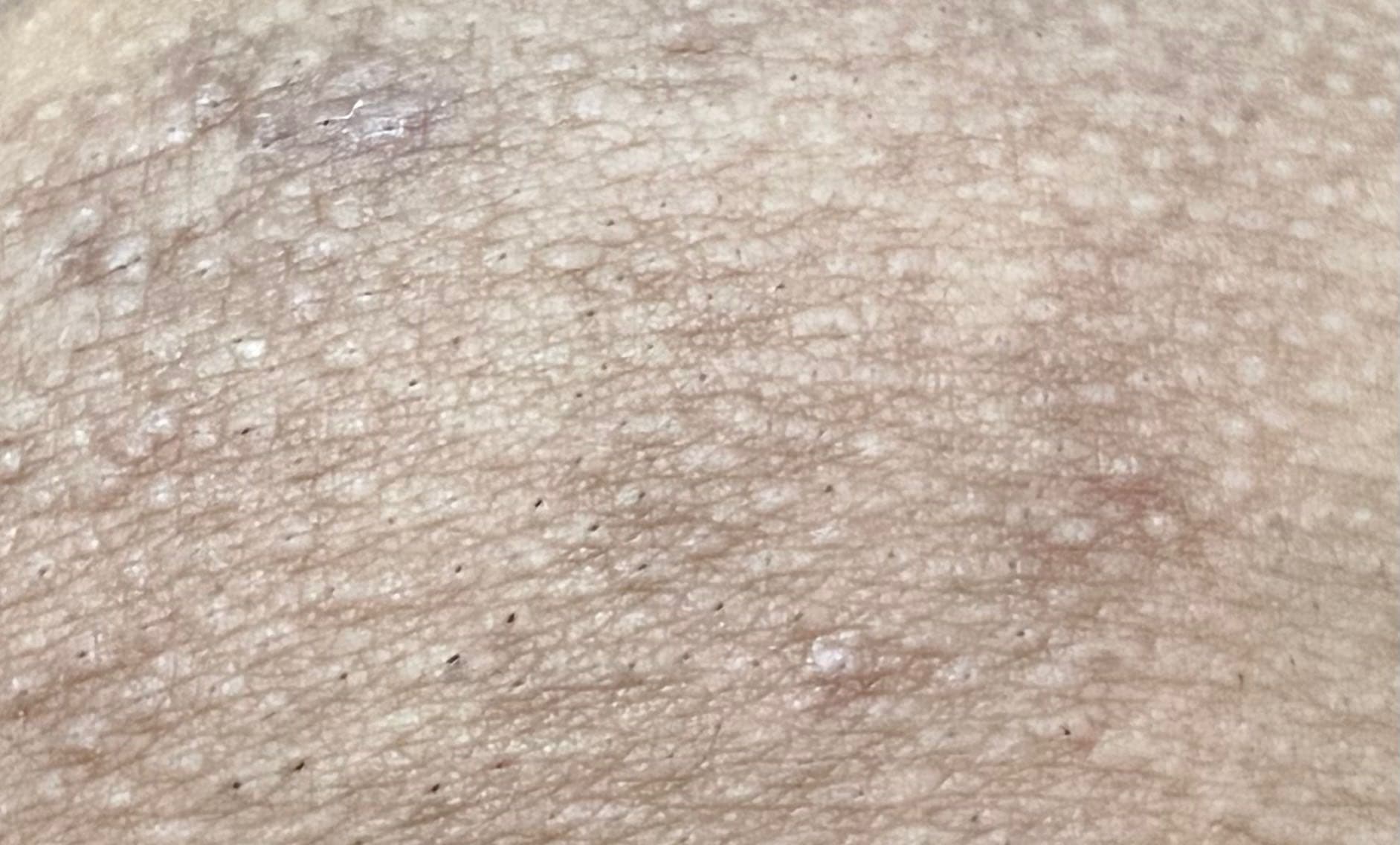 私密處濕疹 - 女孩板 | Dcard