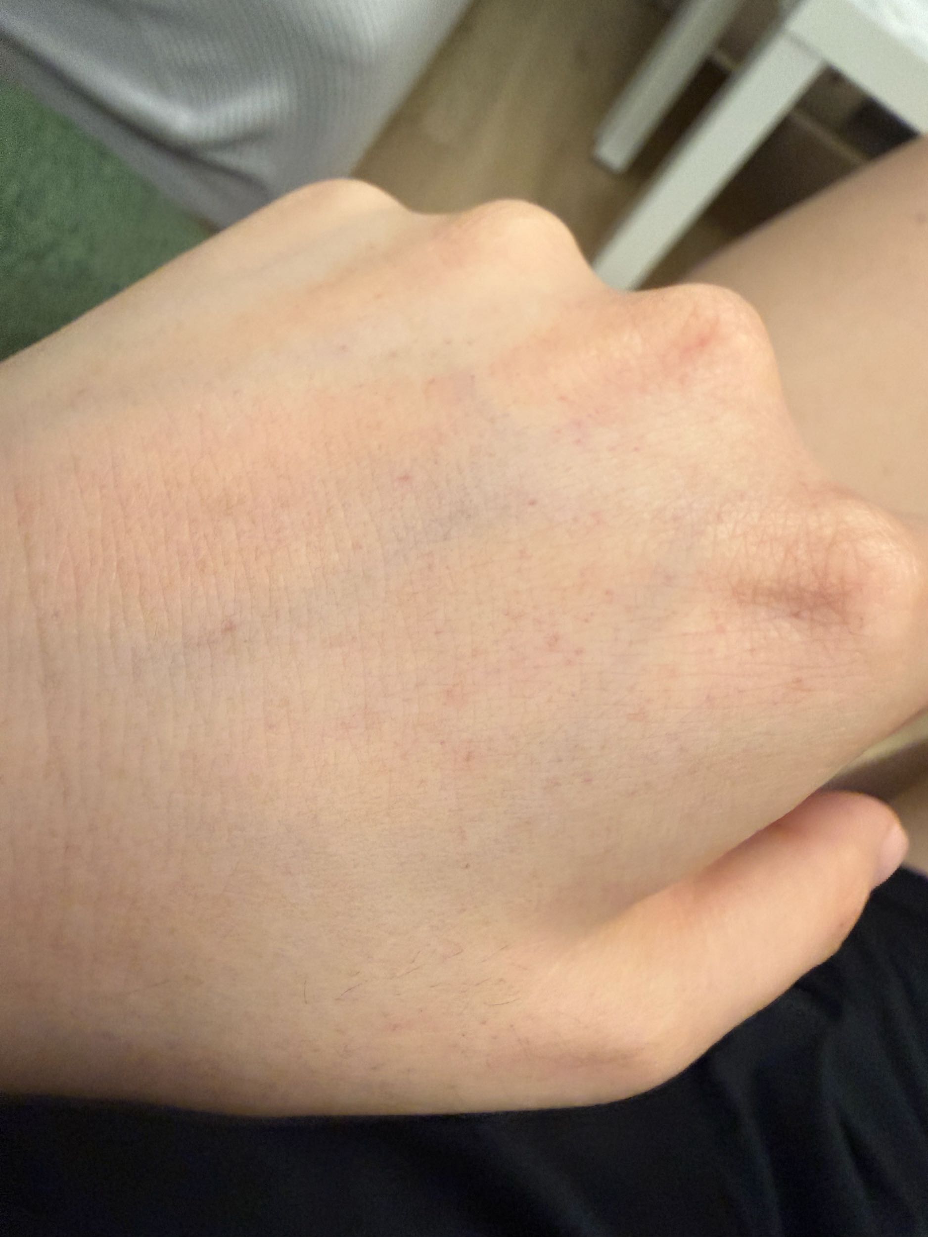 請益#請益重訓完手背出現紅點- 健身板| Dcard