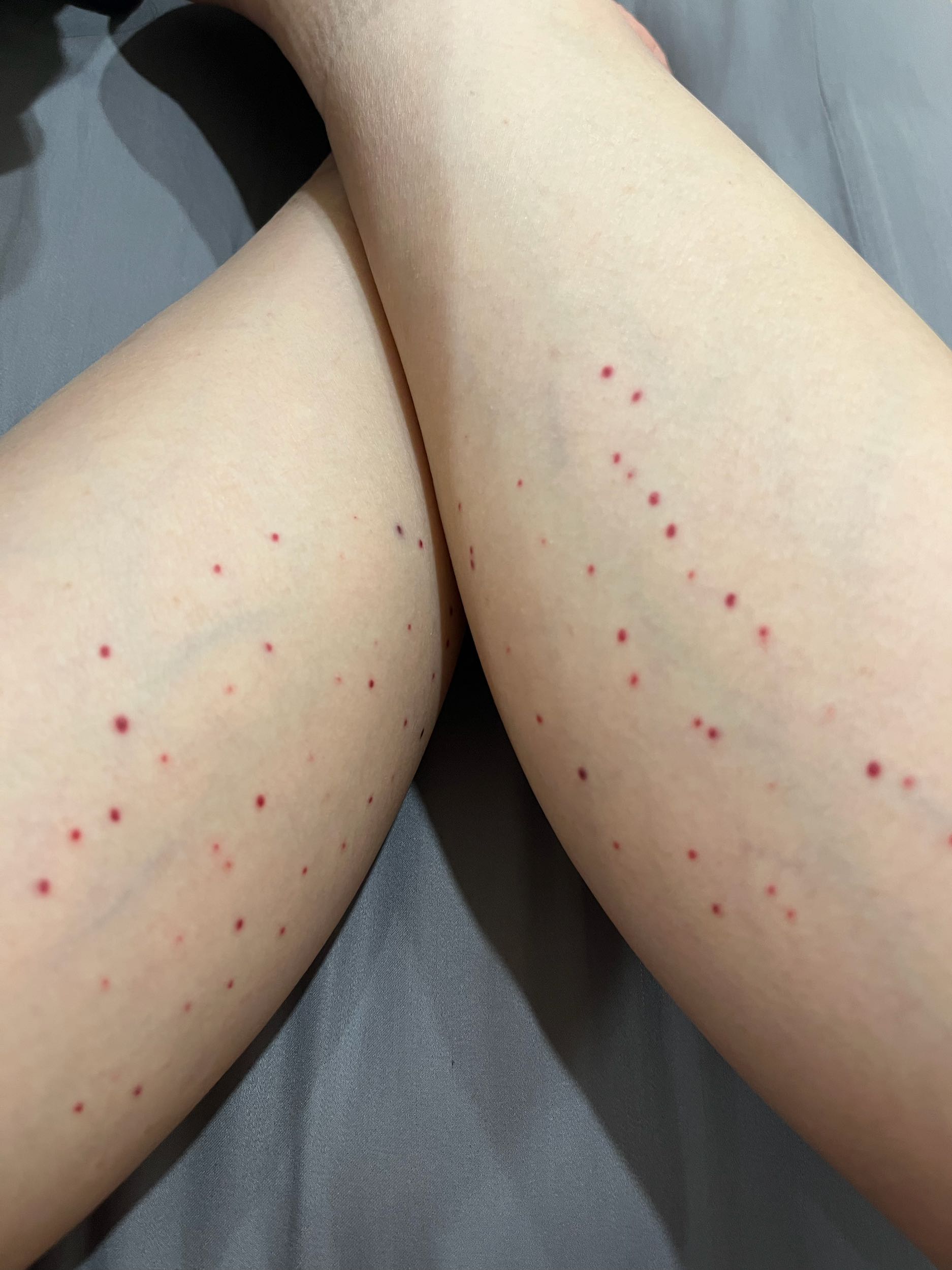 詢問打完肉毒的小腿很多紅點- 醫美板| Dcard