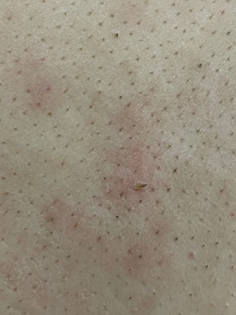 背上的粉刺(密集恐懼甚入 - 粉刺愛好者板 | Dcard