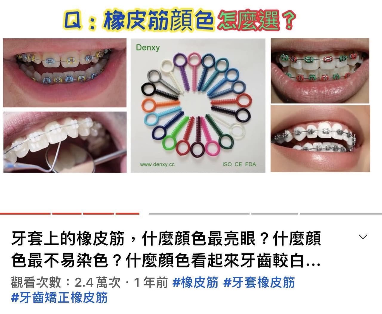 那些關於牙套我不懂的流行（？ - 閒聊板| Dcard