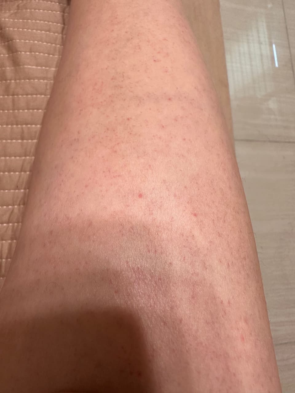 皮膚紅點- 女孩板| Dcard