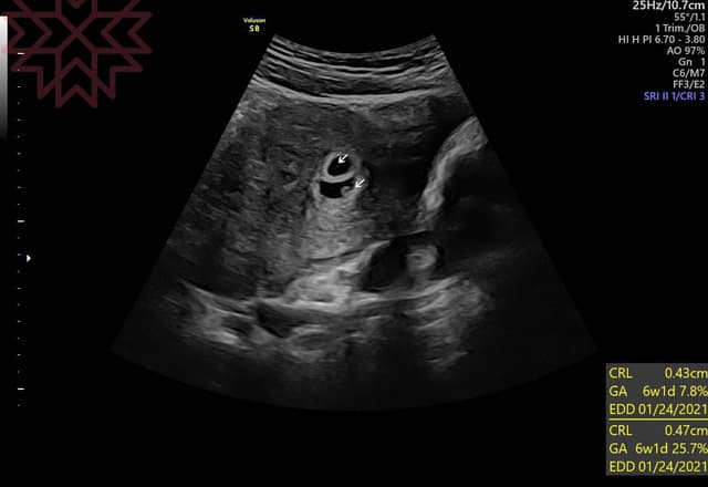 有可能是雙胞胎嗎 親子板 Dcard