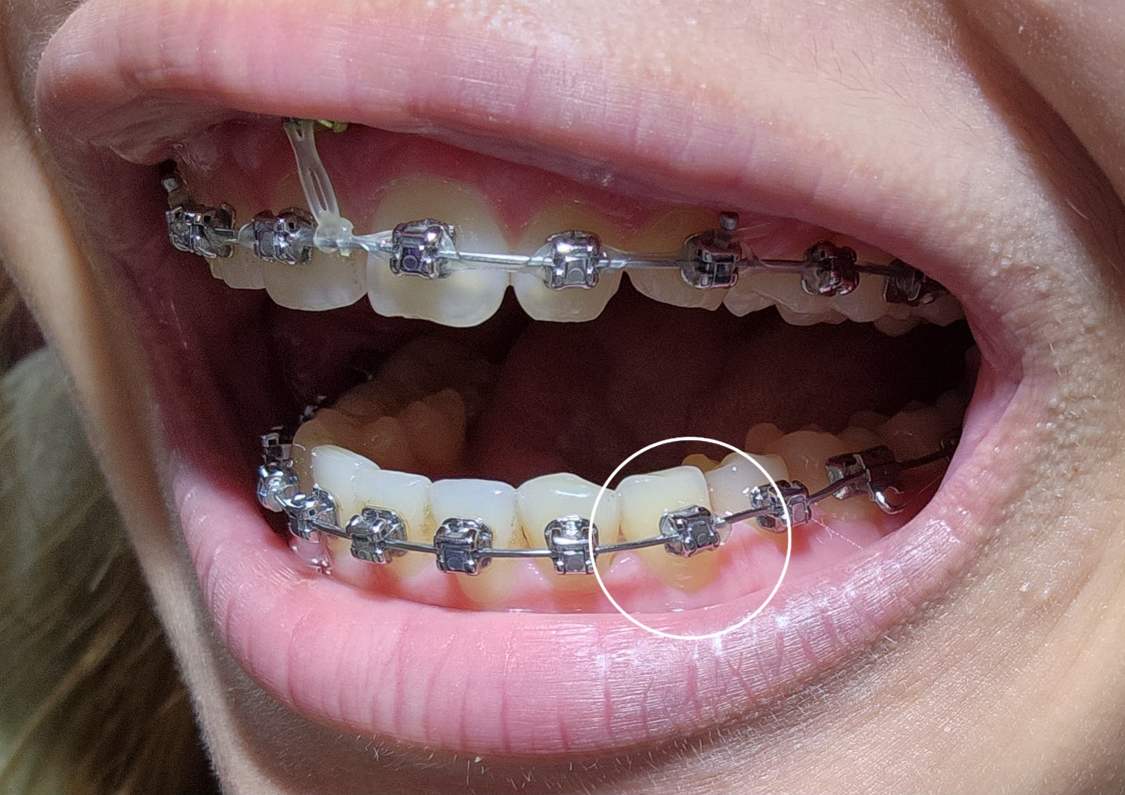 閒聊 沒綁power chain也會痛的嗎 牙齒矯正板 Dcard