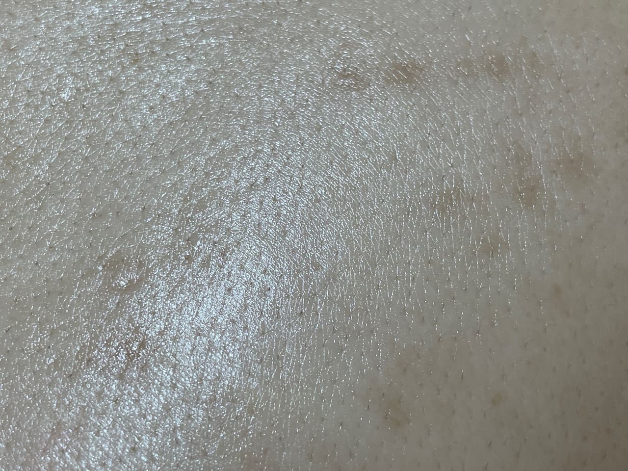 摸不下去的背 粉刺林毛毛篇 - 粉刺愛好者板 | Dcard