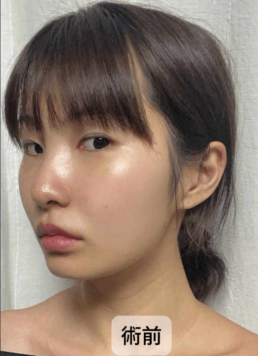 #分享 為什麼要隆鼻?! - 醫美板 | Dcard